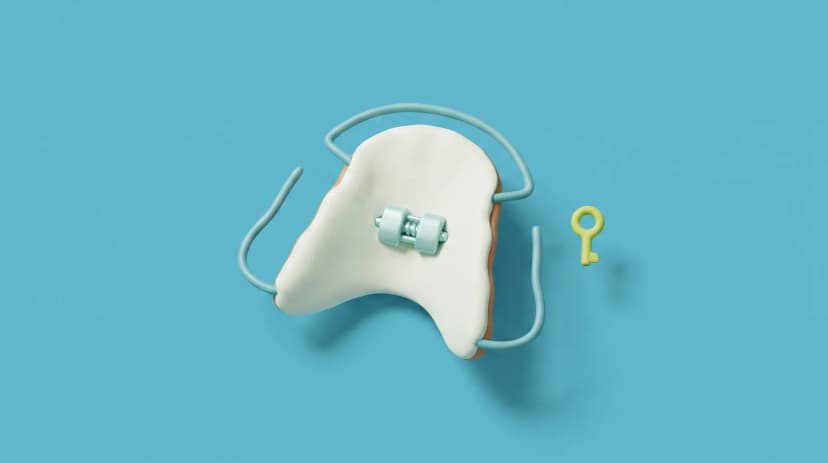 Ilustración de un expansor palatino infantil con su llave de activación